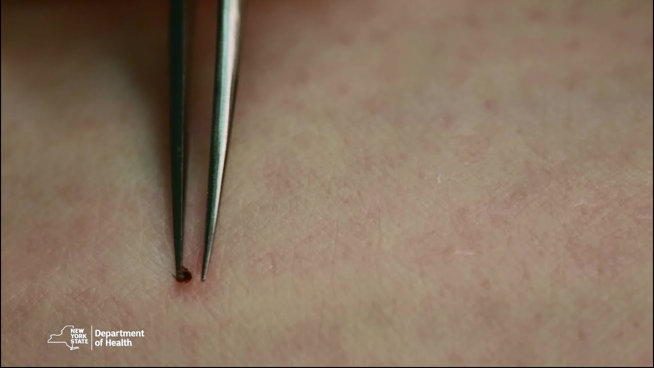Proper Tick Removal