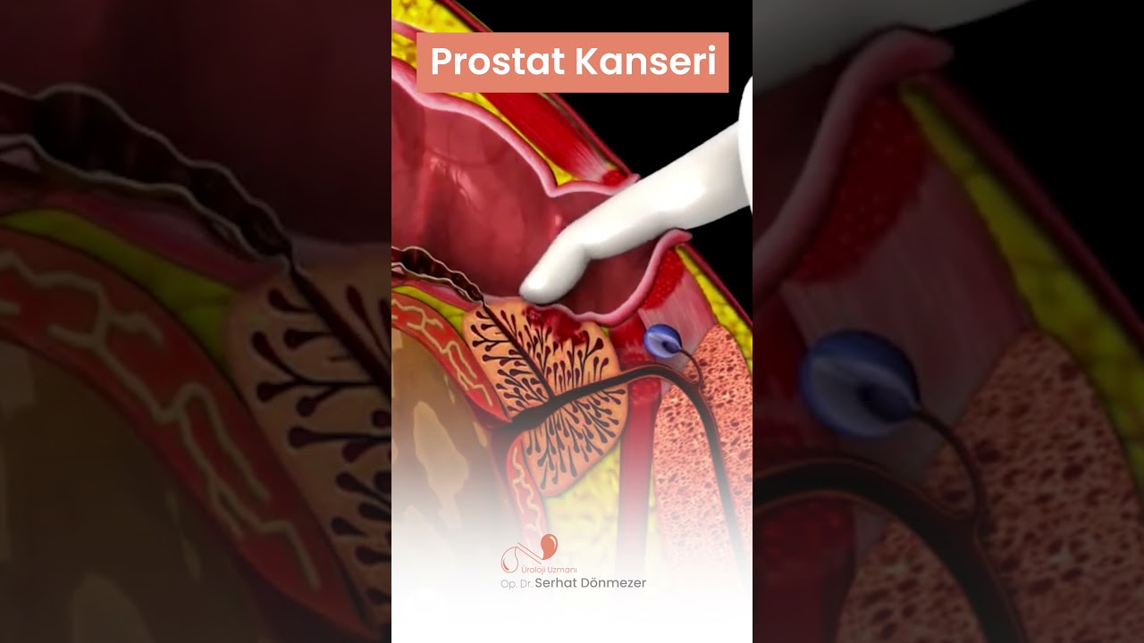Prostat Kanseri | Op. Dr. Serhat DÖNMEZER