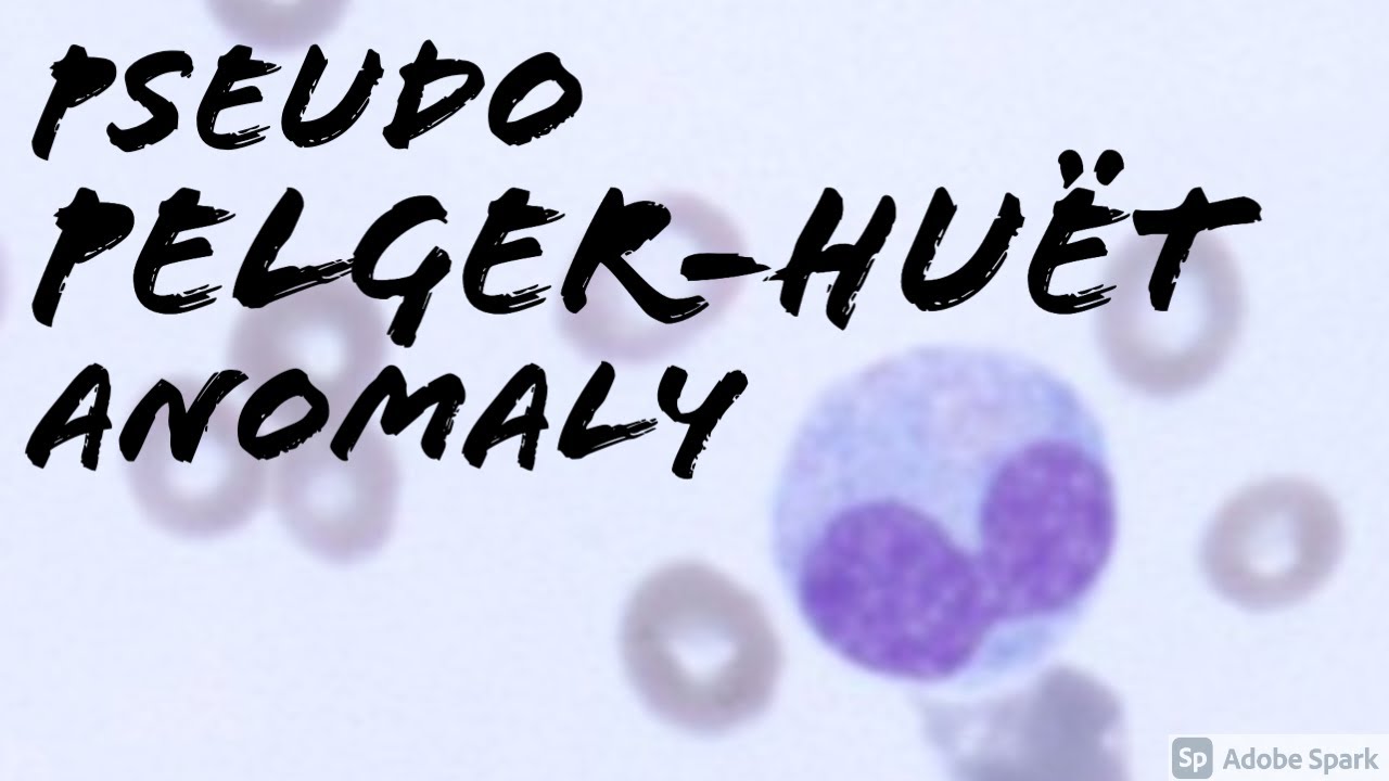 Pseudo Pelger-Huët Anomaly (Peripheral Blood Smear, Hematopathology, Hematology)