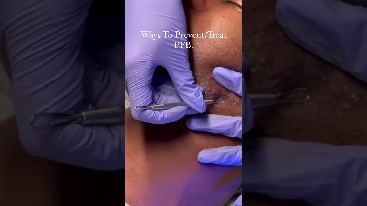 Psuedofolliculitis Barbae Treatment