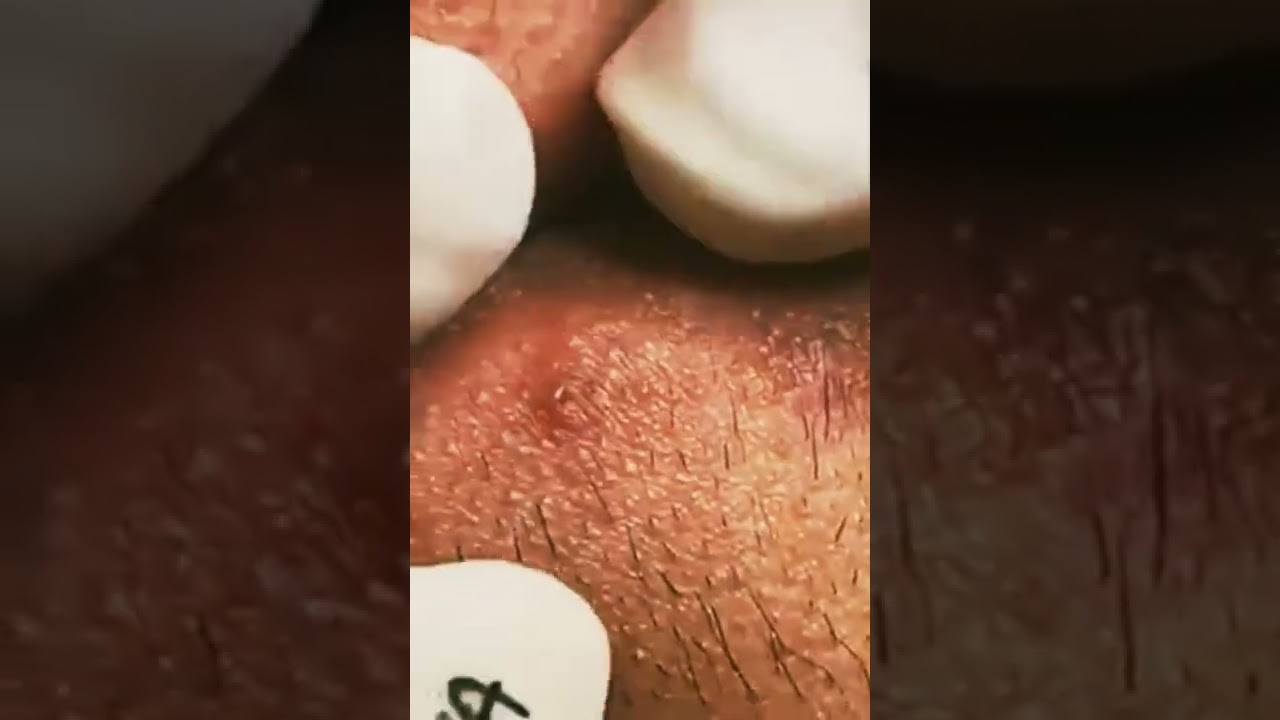 Puntos negros en el labio.