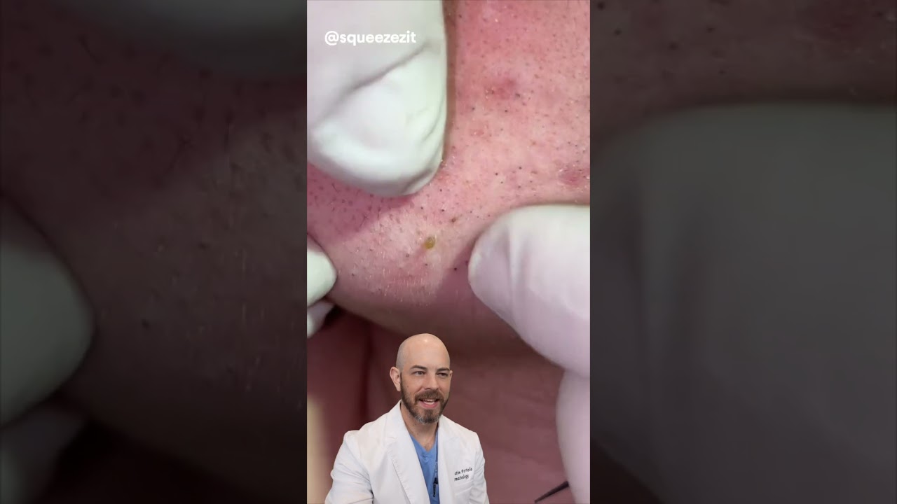 Quick and easy chin blackhead pop!💥💥 (credit: @squeezezit on TT) #doctor #satisfying #viral