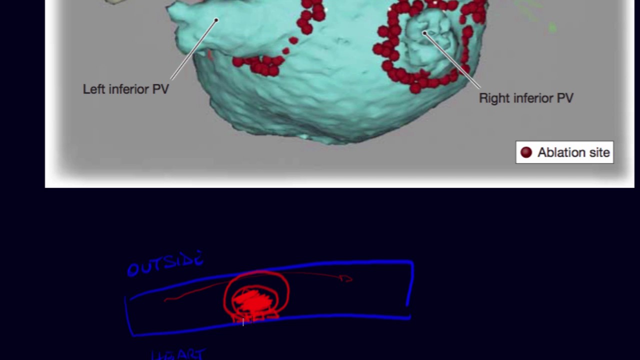 Radiofrequency ablation for isolation of pulmonary veins in patients with atrial fibrillation
