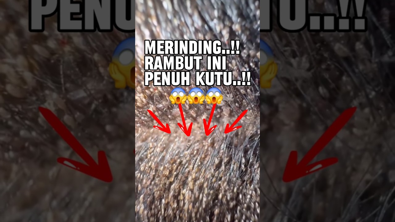 Rambut Penuh Kutu! Bikin Merinding Banget? 😱 #reaction #short #shorts