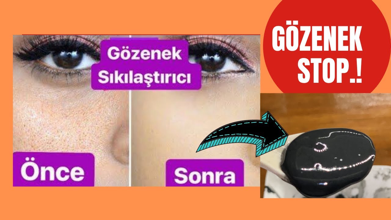 REKOR KIRACAK 1 DAKİKADA GÖZENEKLERDEN LEKELERDEN KURTULACAKSINIZ / ŞOK OLACAKSINIZ / ANINDA ETKİ...