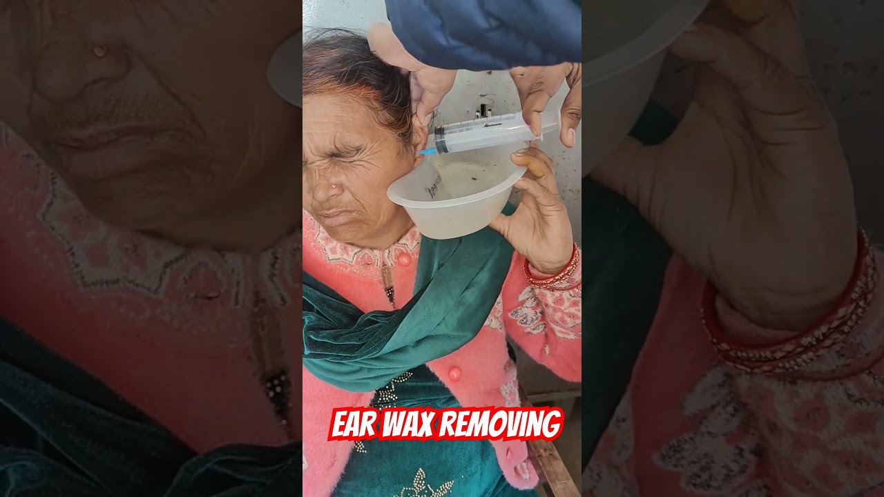 Removal of Ear Wax by Syringing Method #trending #viral #motivation #ytshorts #bamslife #mbbs#doctor
