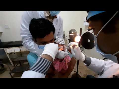 Removal of foreign body nose