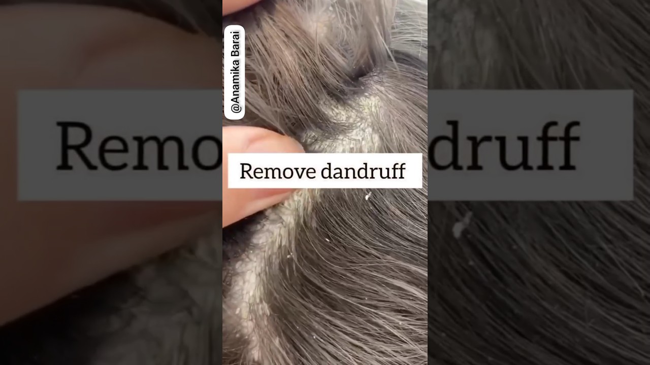 💯Remove Dandruff Just In 1 Wash🔥#dandruff #haircare #hairfall #hairgrowth #viral #1m #short #shorts