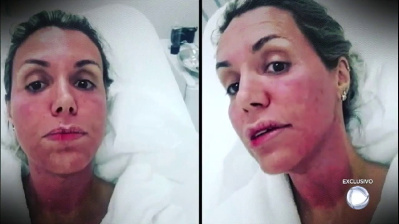 Renata Banhara fala da luta contra doença grave: “Minha cabeça chegou a pesar um 1,5 kg a mais”