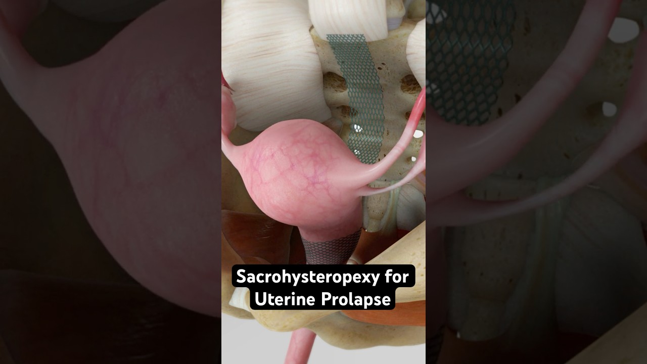 Restoring a fallen uterus (3D animation)