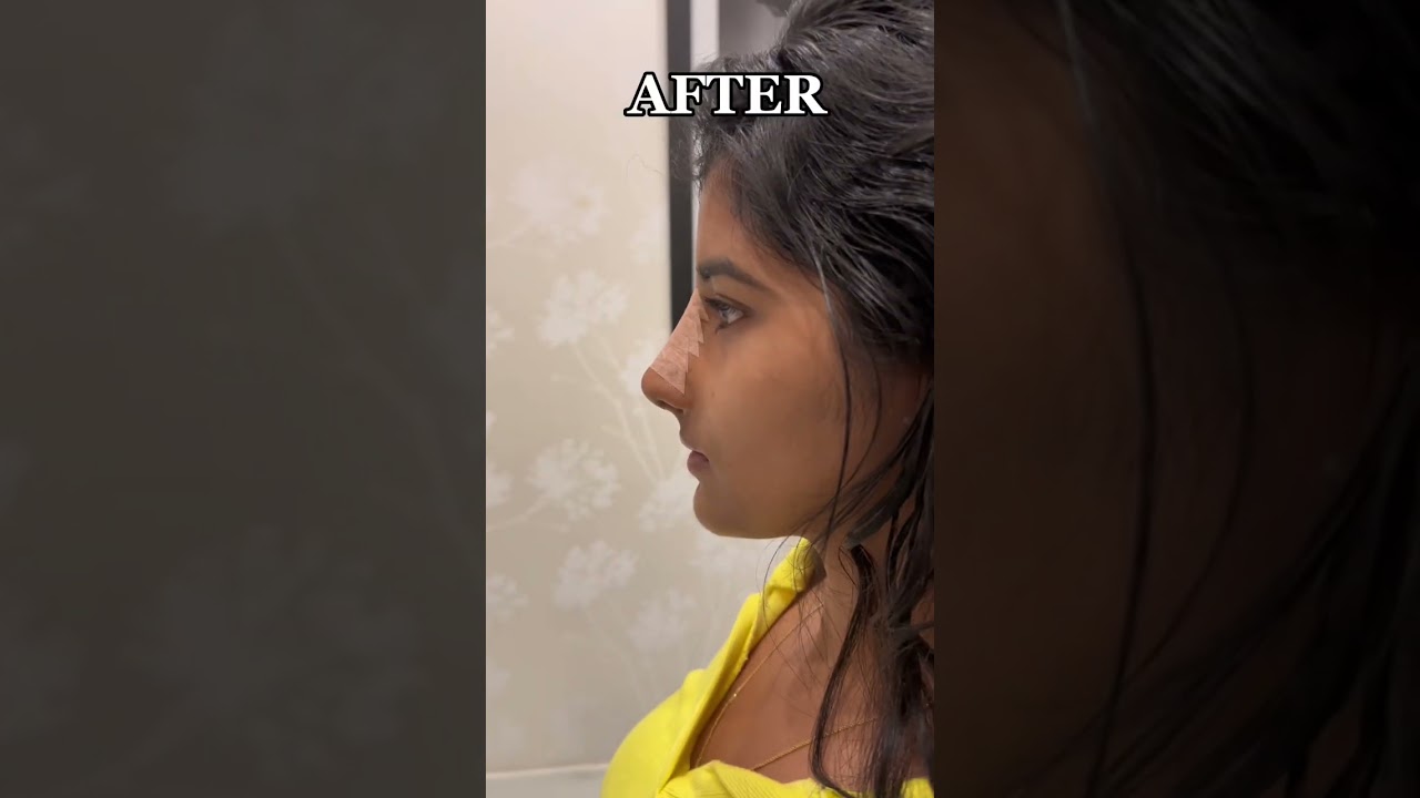 Revision Rhinoplasty for my beautiful patient from India 🇮🇳🤍 #rhinoplasty #nosejob #india