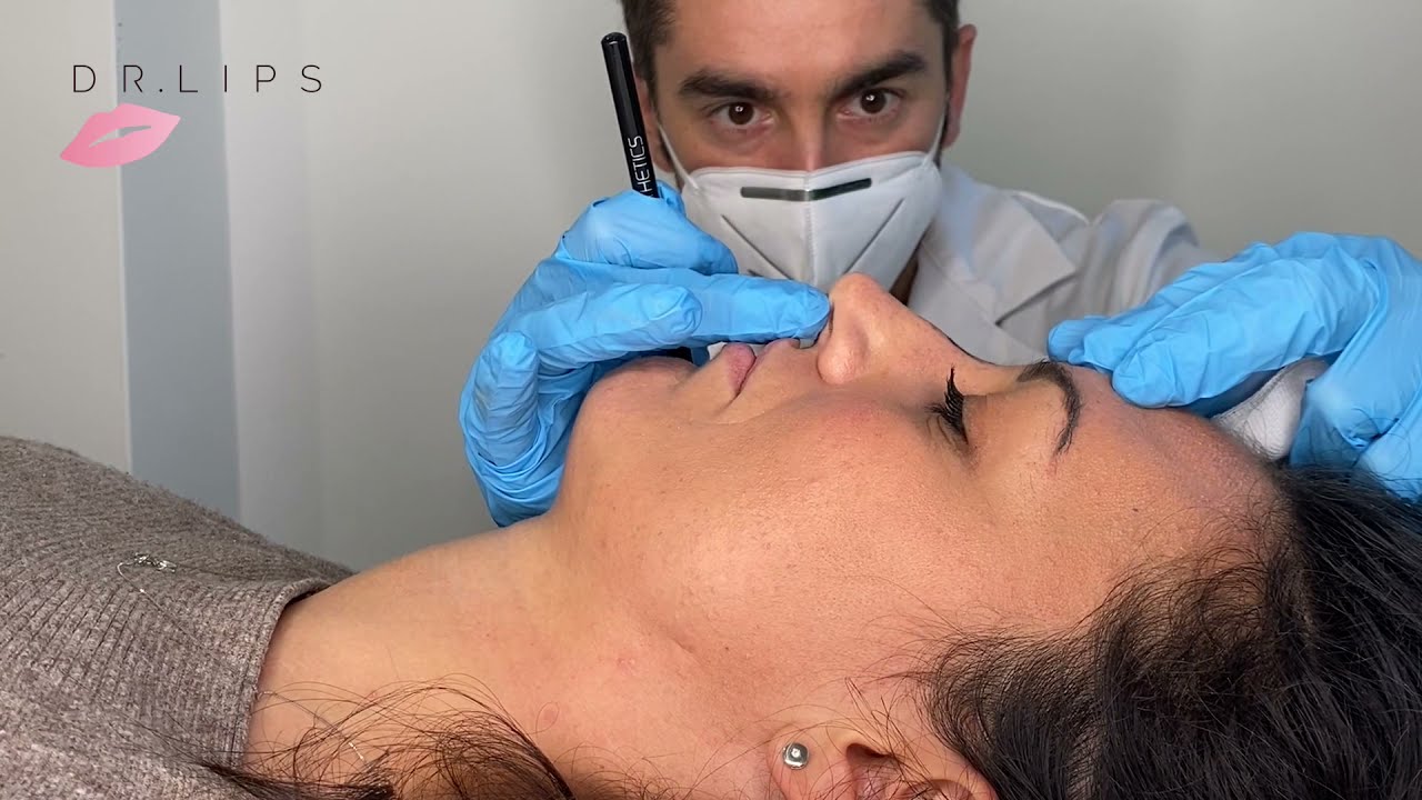 Rinofiller & iFACE : non surgical rhinoplasty with Belotero Intense by Merz