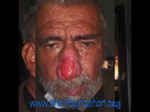 Roger’s Nose Transformation: As seen on Dr. Pimple Popper’s Season 6, Episode 2