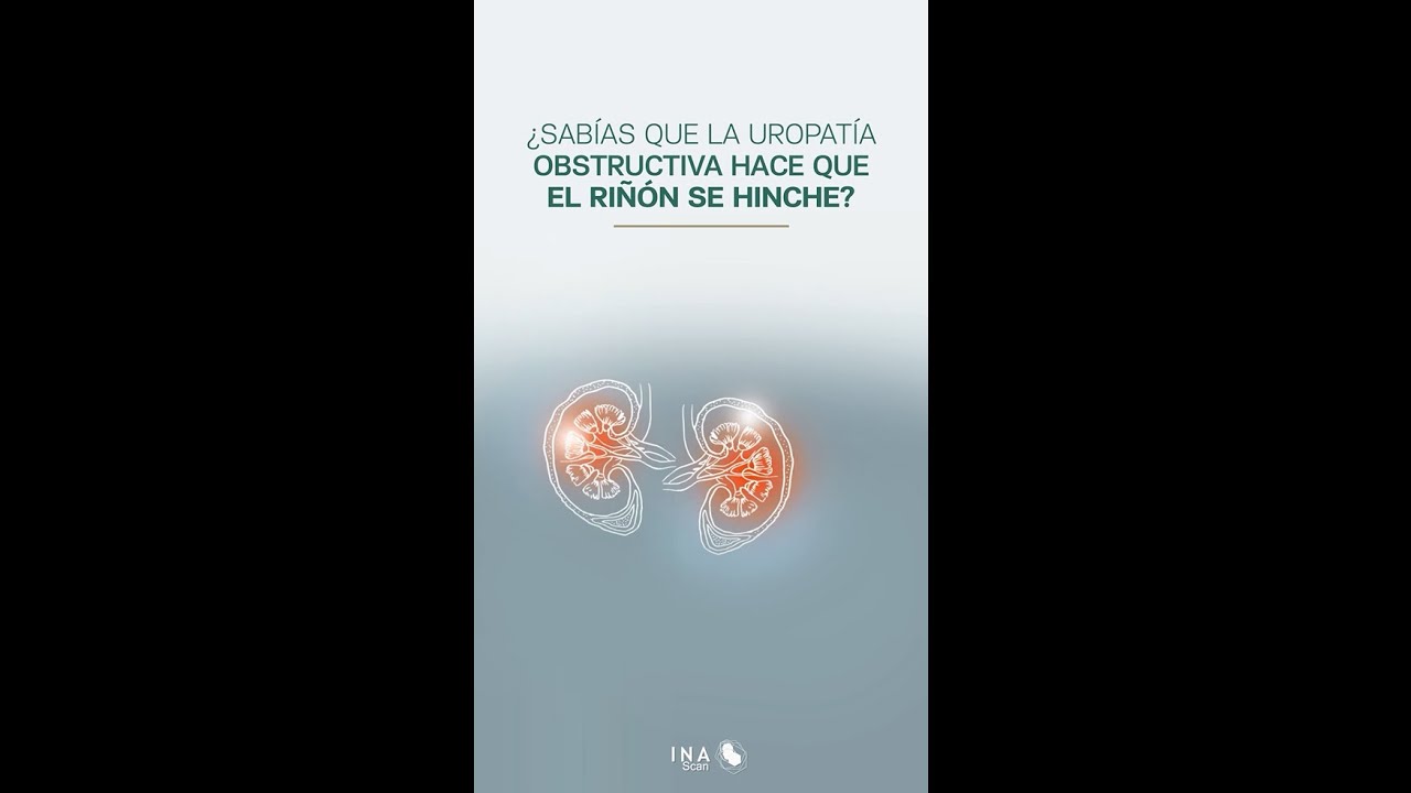 ¿Sabías que la uropatía obstructiva hace que el riñón se hinche?