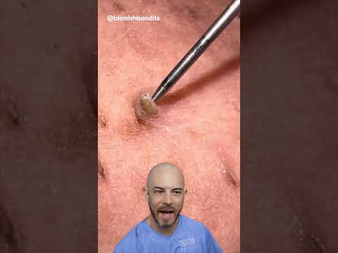 Satisfying impacted hair removal from the armpit!(credit: @blemishbandits on TT) #doctor #satisfying