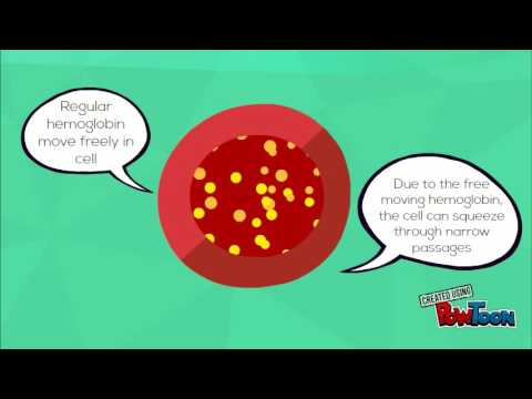 SCD causing stroke