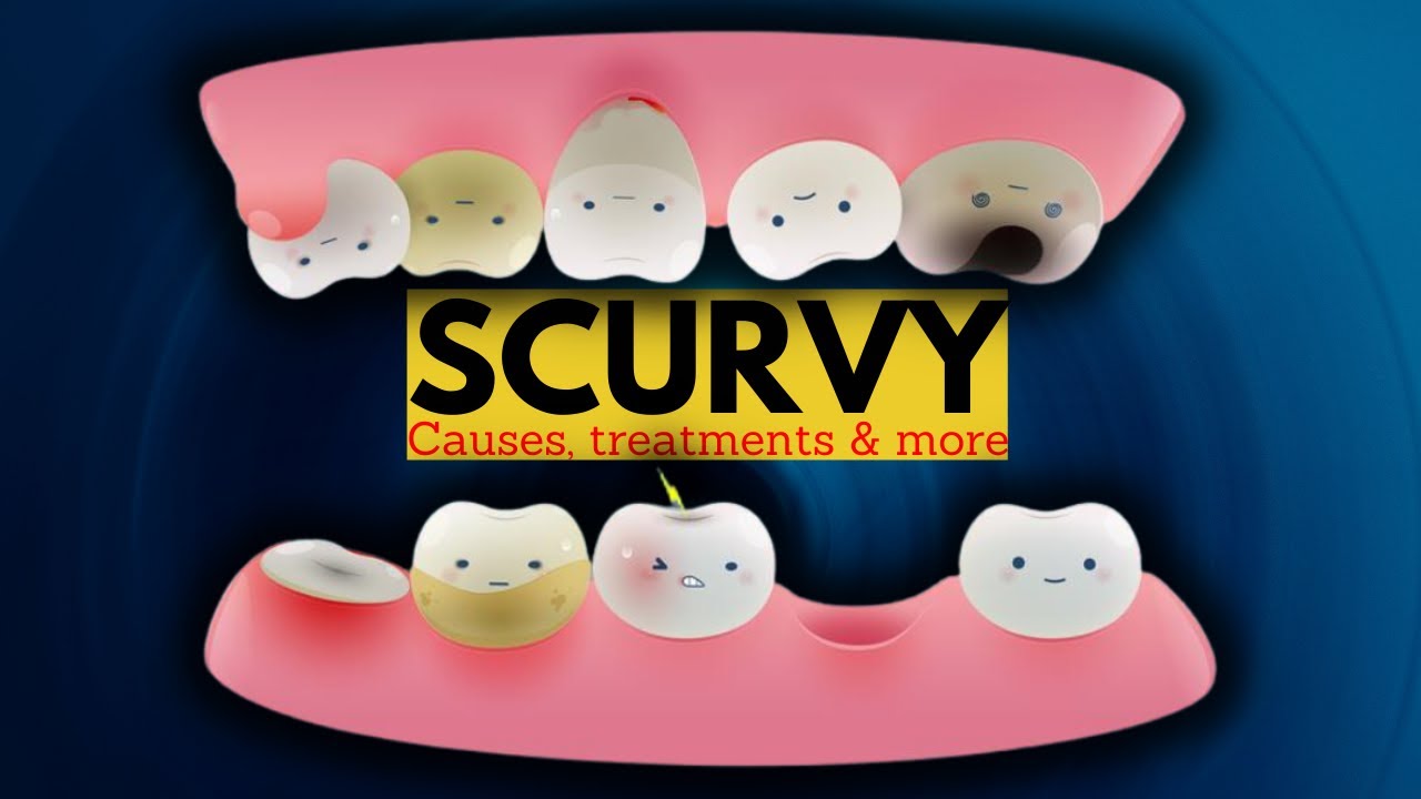 Scurvy : Symptoms, Causes, Treatment, And Prevention