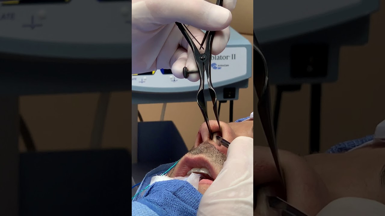 Septoplasty - Septal Incision