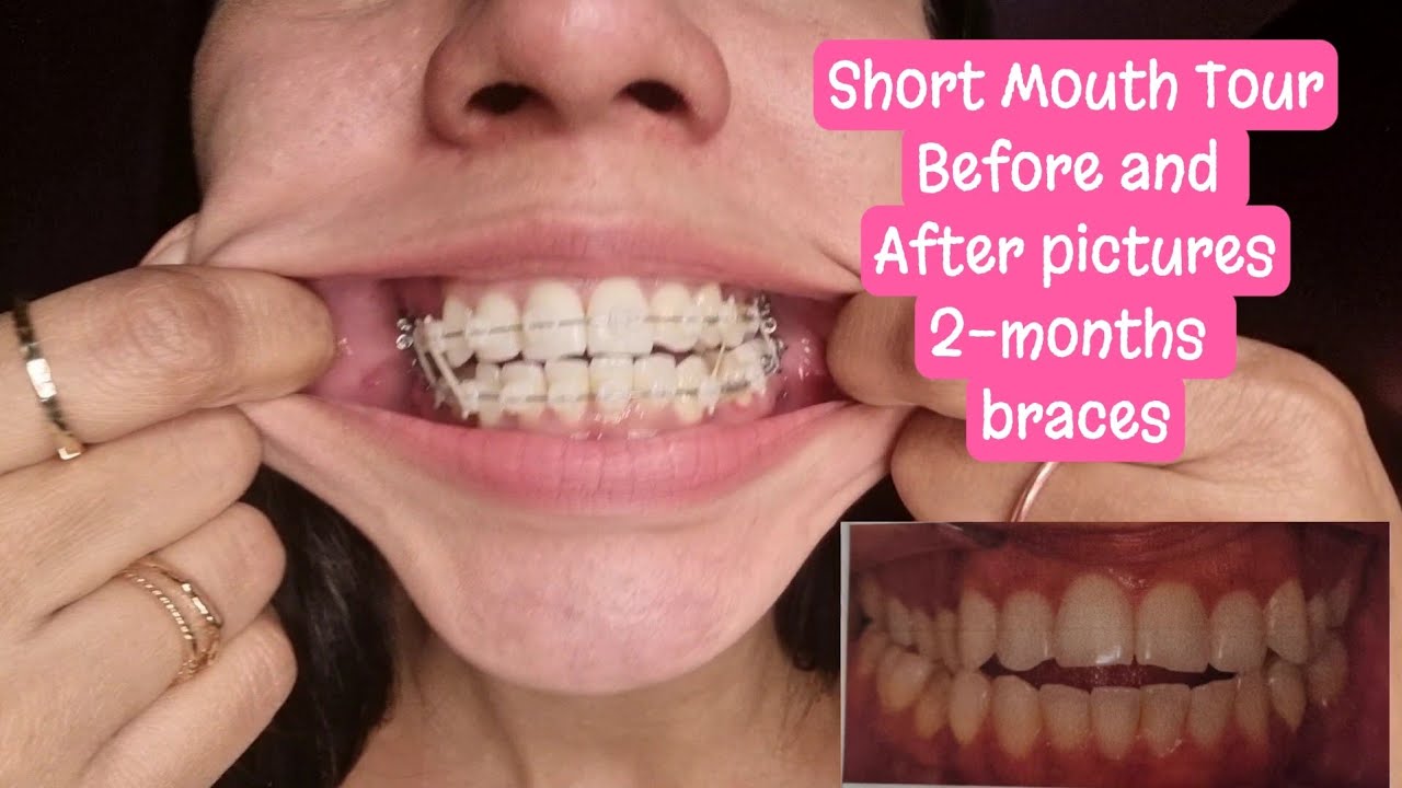 💕Short Mouth Tour and Before and After pictures 💕- 2 months update.
