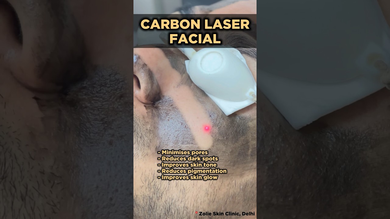 Skin Glow Laser | Carbon Laser Facial | Carbon Laser Treatment | Carbon Peel | Skin Clinic Delhi