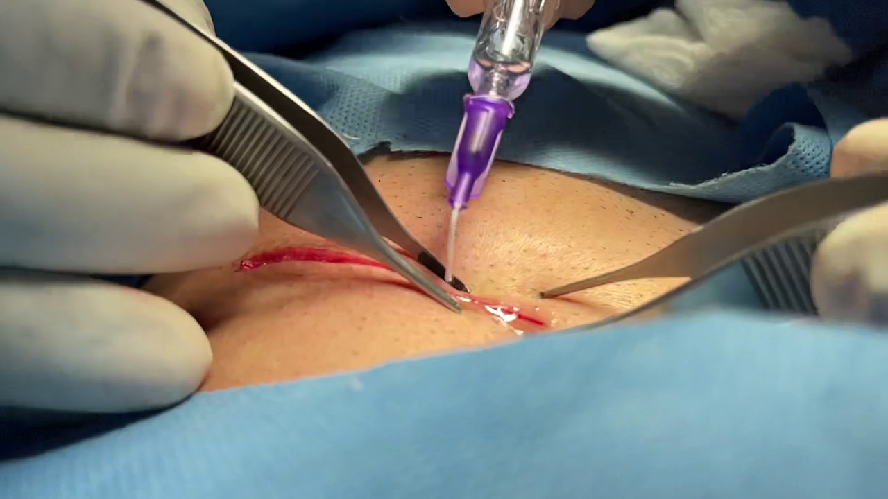 Skin Glue to get better results faster