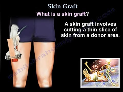Skin Graft - Everything You Need To Know - Dr. Nabil Ebraheim