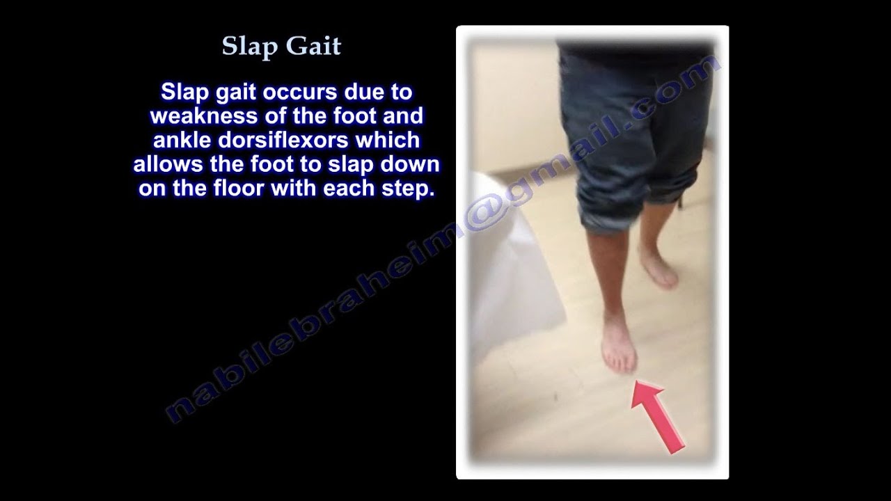 Slap gait , Steppage Gait . Foot Drop - Everything You Need To Know - Dr. Nabil Ebraheim