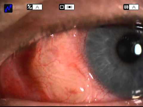 Solitary Subconjunctival Moving Parasite- Dirofilaria repens.
