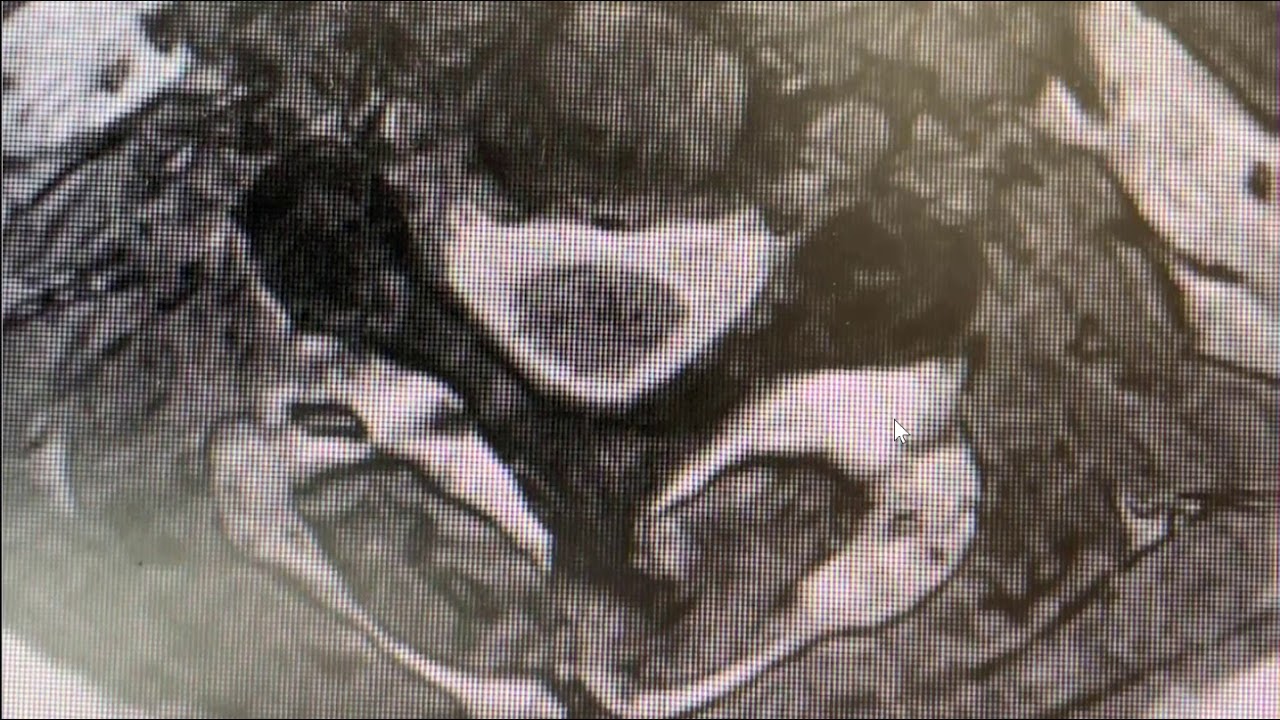 Spine Conference cervical radiculopathy