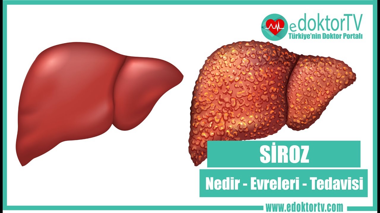 SİROZ (Siroz Nedir - Siroz Kanseri - Sirozun  Evreleri - Sirozun Tedavisi)
