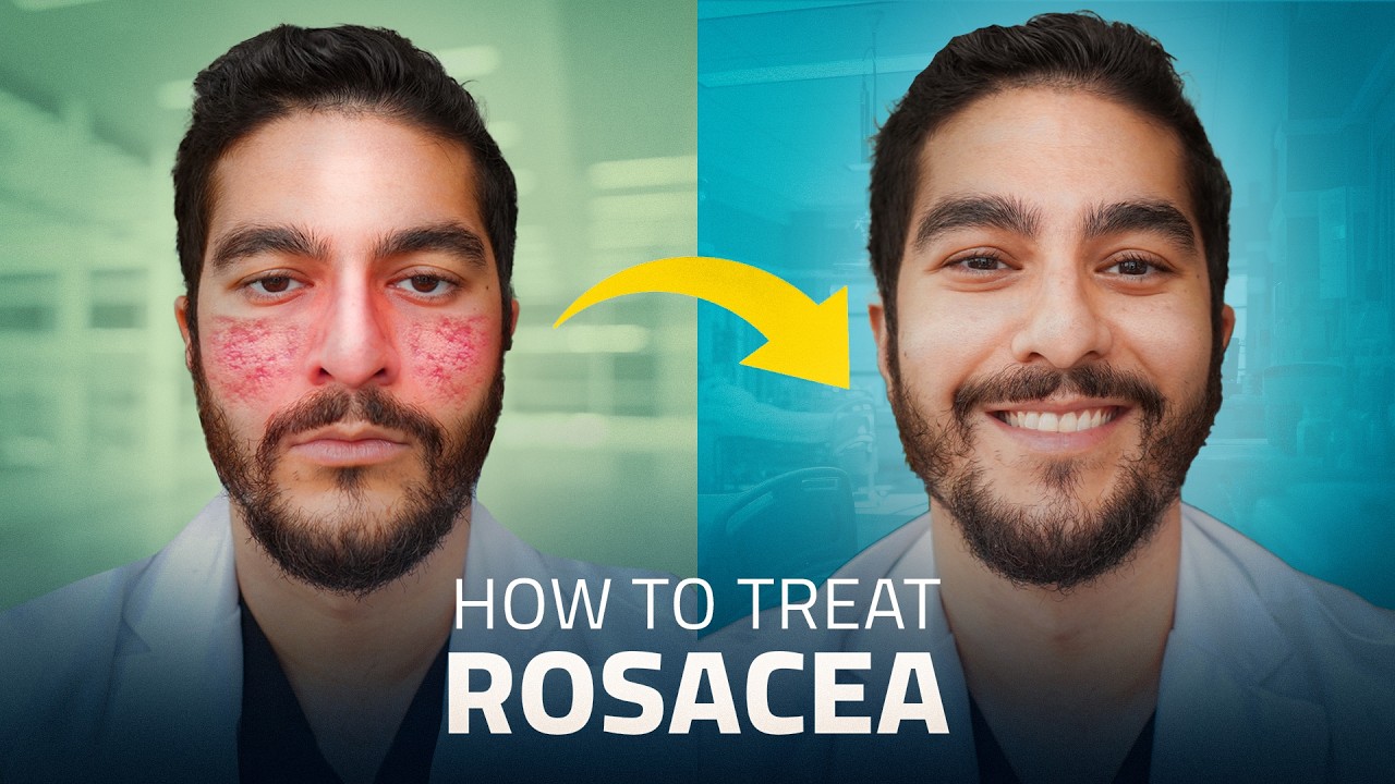 Struggling with Rosacea? Here Are the Best Treatments for 2025
