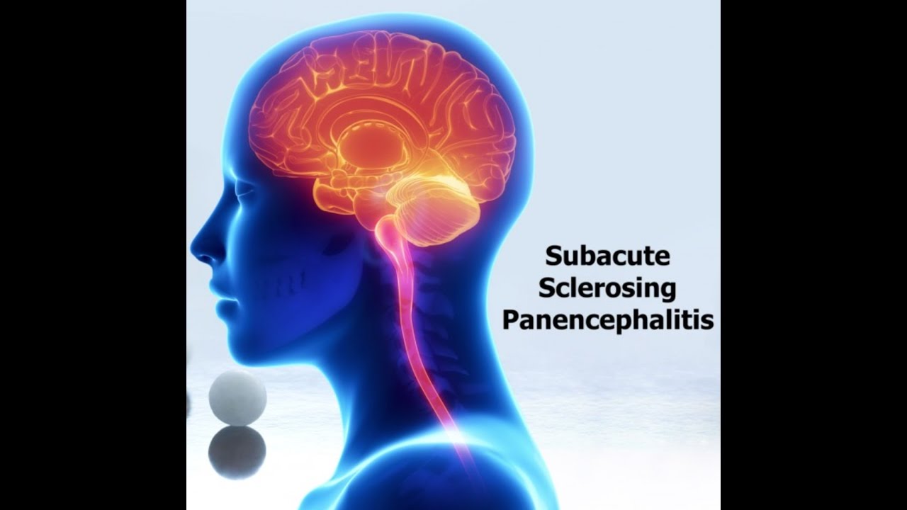 Subacute sclerosing panencephalitis (SSPE)