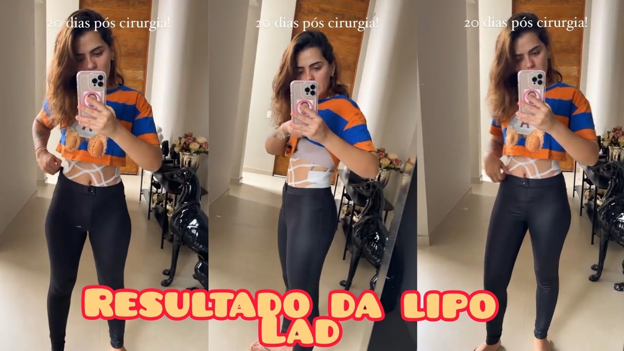 SUNAIKA BRUNA MOSTRA RESULTADO DA SUA CIRURGIA LIPO LAD!!