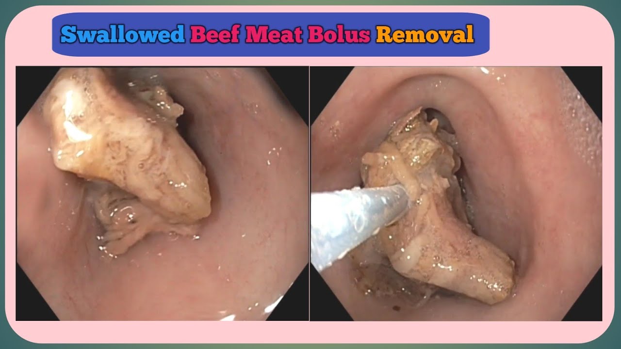 Swallowed Meat Bolus Removal From Esophagus #BD_ENDOSCOPY
