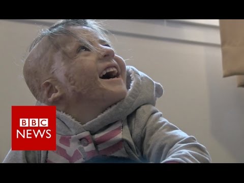 Syrian girl with severe burns gets life-changing surgery - BBC News