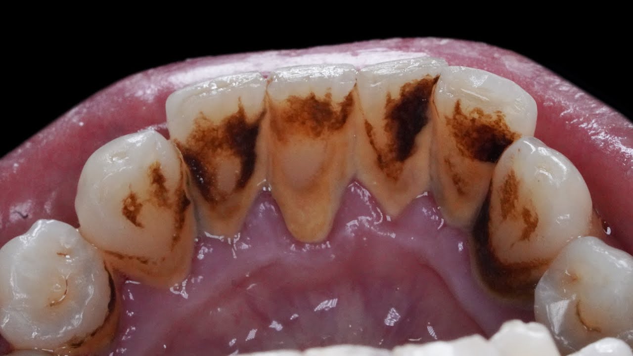 TARTAR - 20 yo. Female's Teeth