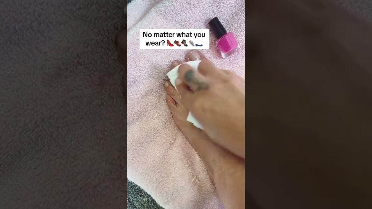 Team sweaty feet! 🦶🏻💦 We can help! (Dermadry for hyperhidrosis)