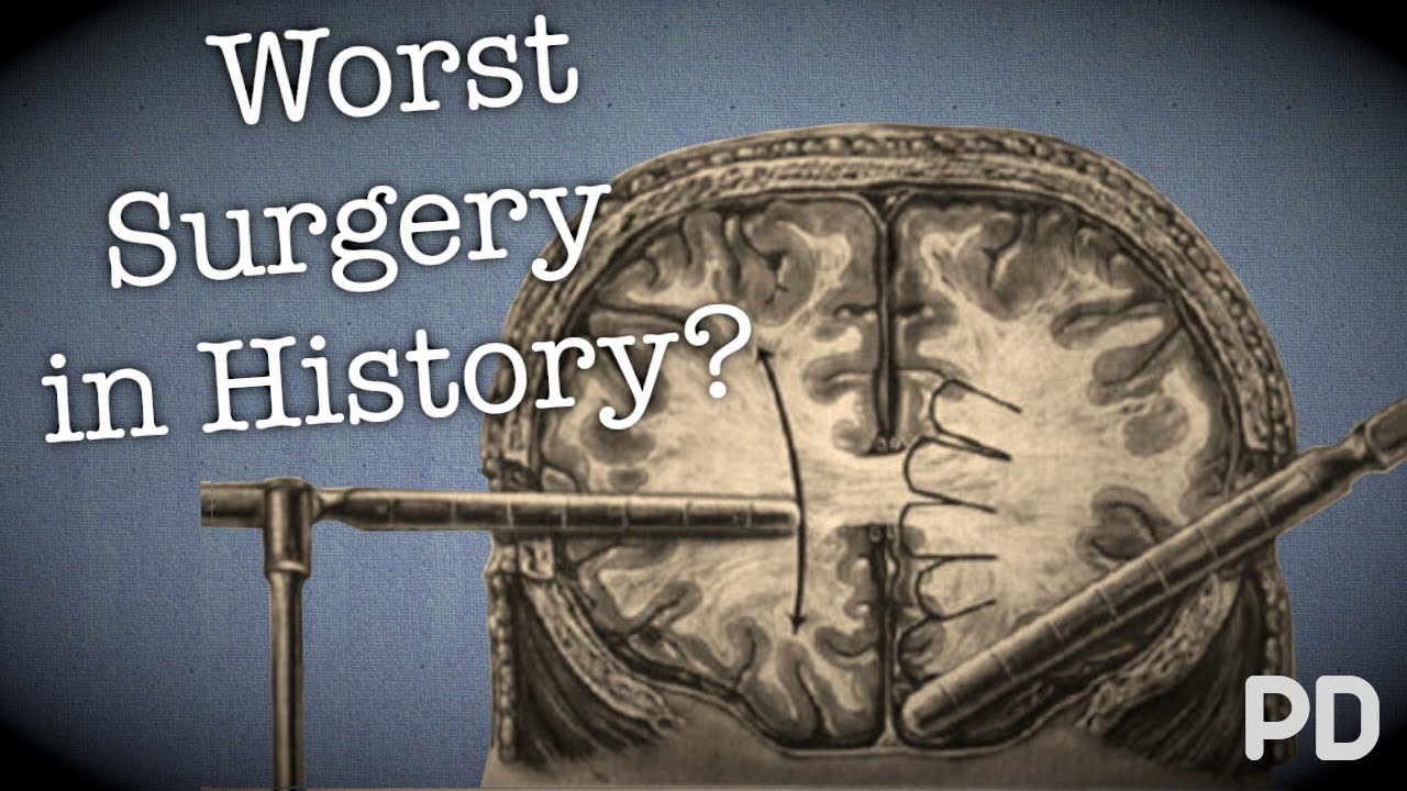 The Dark side of Science: The Lobotomy, the worst surgery in history? (Documentary)