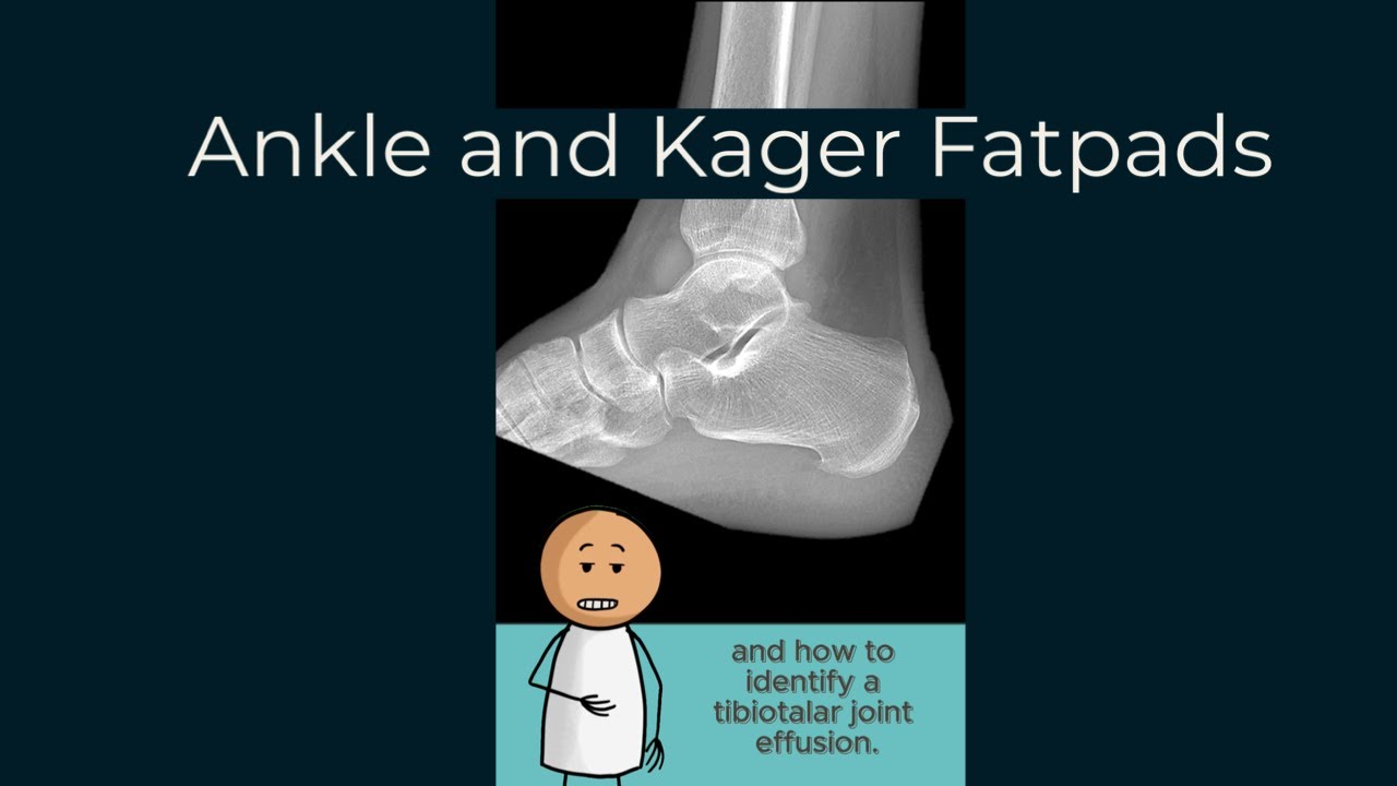 The Kager Fat Pad and Tibiotalar joint effusion.