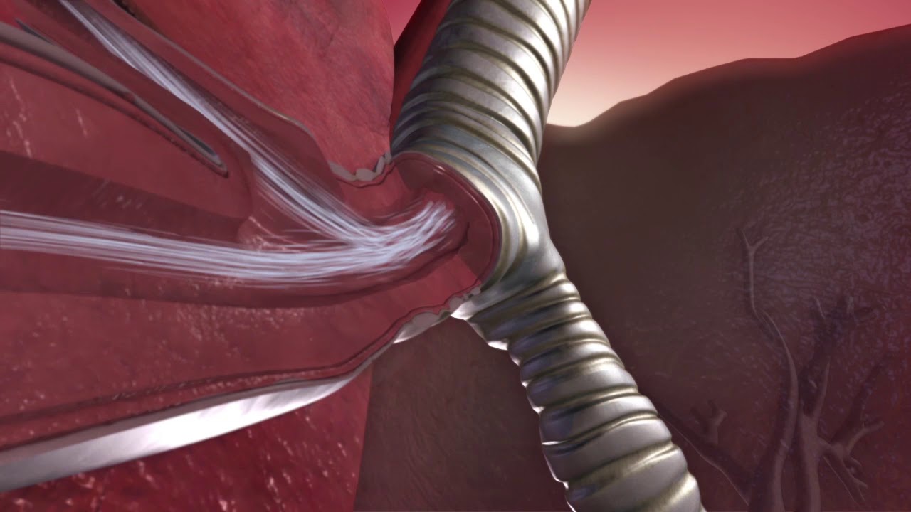 The Mechanics of an Asthma Attack. An Animated Insight