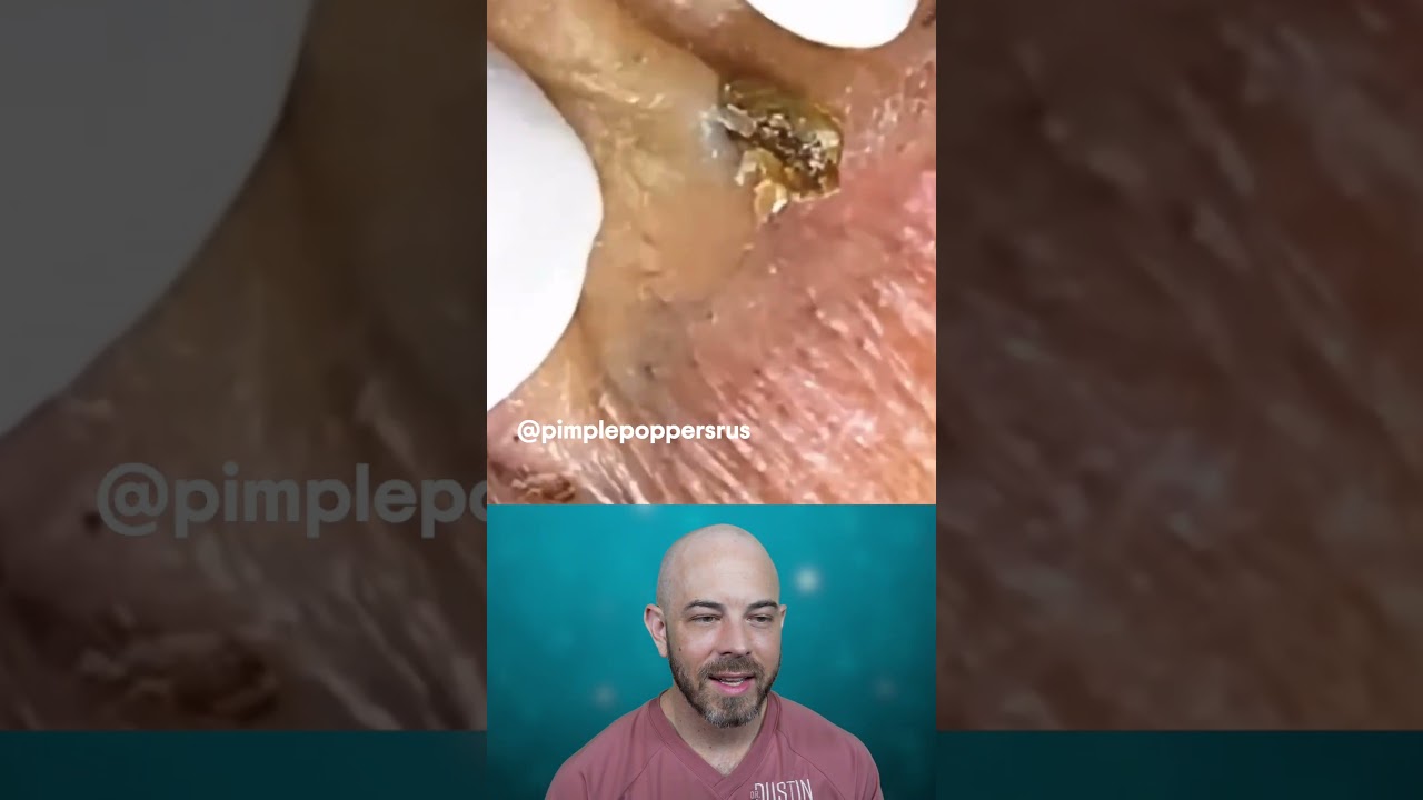 This cyst doesn’t go quietly 👀💥 You won’t want to miss it! (credit: @pimplepoppersus on TT) #cyst