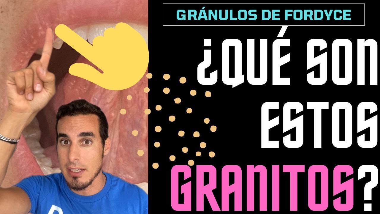 ¿Tienes estos GRANITOS en los LABIOS o GENITALES? Aquí te explico qué es - Fordyce