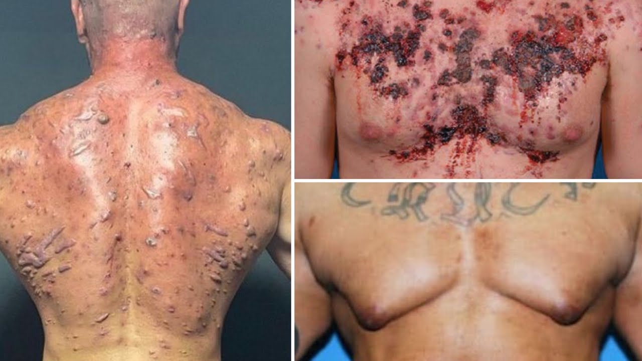 Top 5 WORST Side Effects of Anabolic Steroids [NSFW]