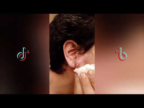 Top best Pimple popping TikTok Videos Compilation #2