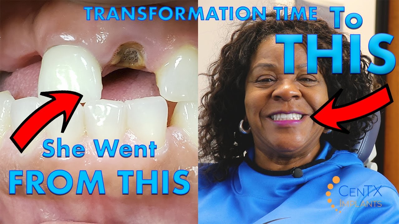 Transformation Time: Kay's New Smile Revealed
