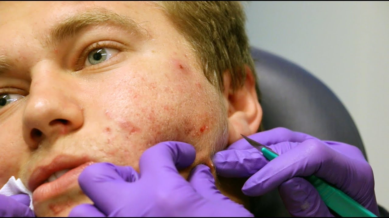 Treating Supreme Patty's Acne