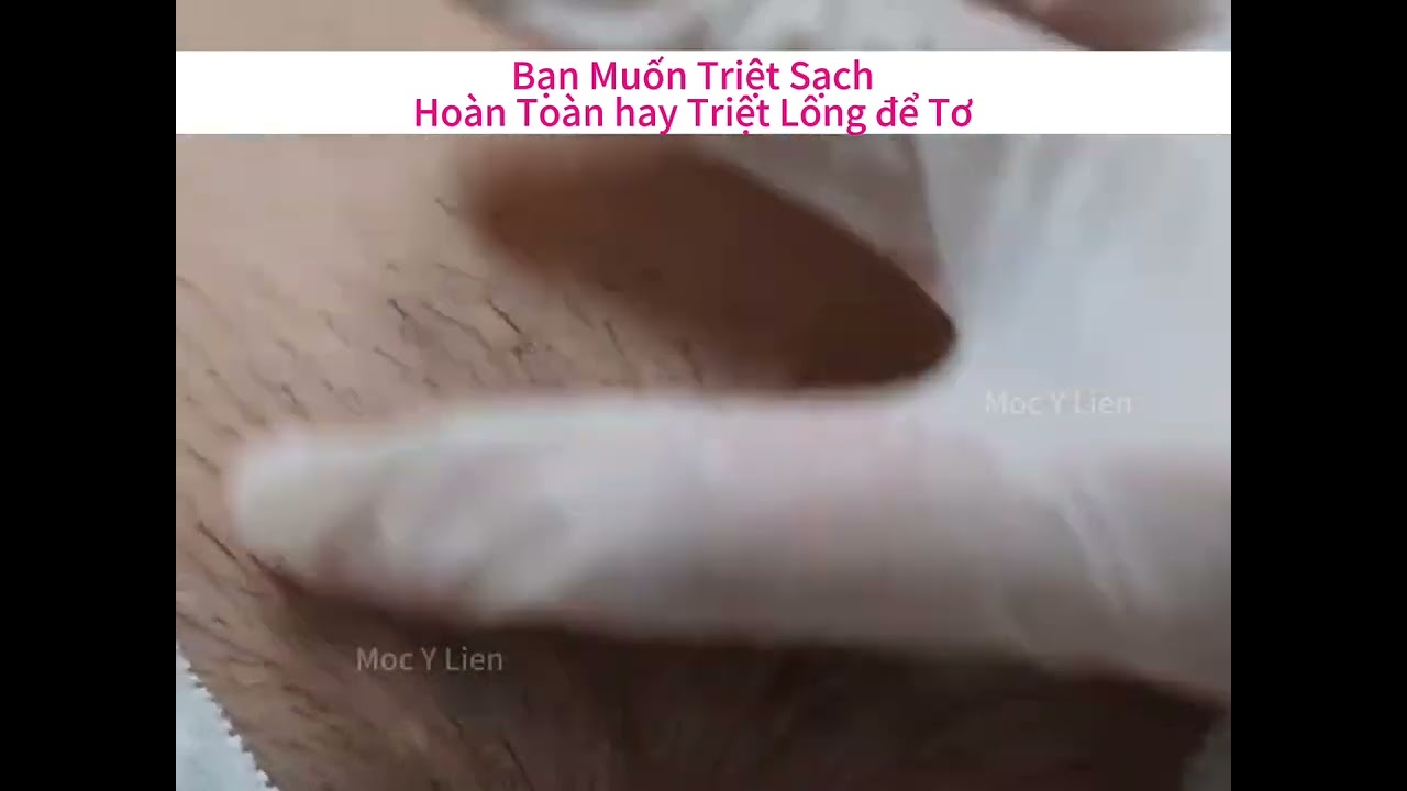Triệt Lông bikini bạn muốn triệt hết sạch hoàn toàn hay triệt lông lông tơ mảnh/ triệt lông bikini