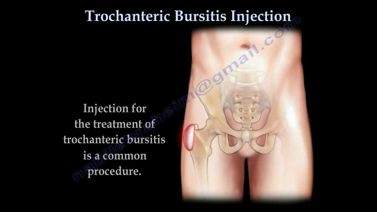 Trochanteric Bursitis Injection - Everything You Need To Know - Dr. Nabil Ebraheim