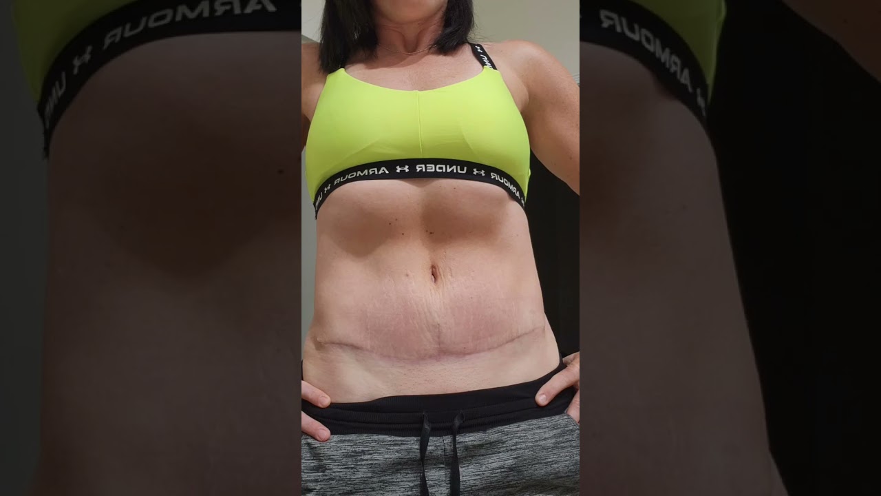 Tummy Tuck Journey Vlog Episode 9 - 4 months Post-Op