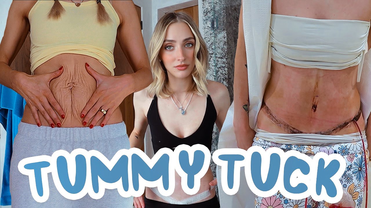 Tummy Tuck Recovery: Week 1 & 2 *very raw and real*